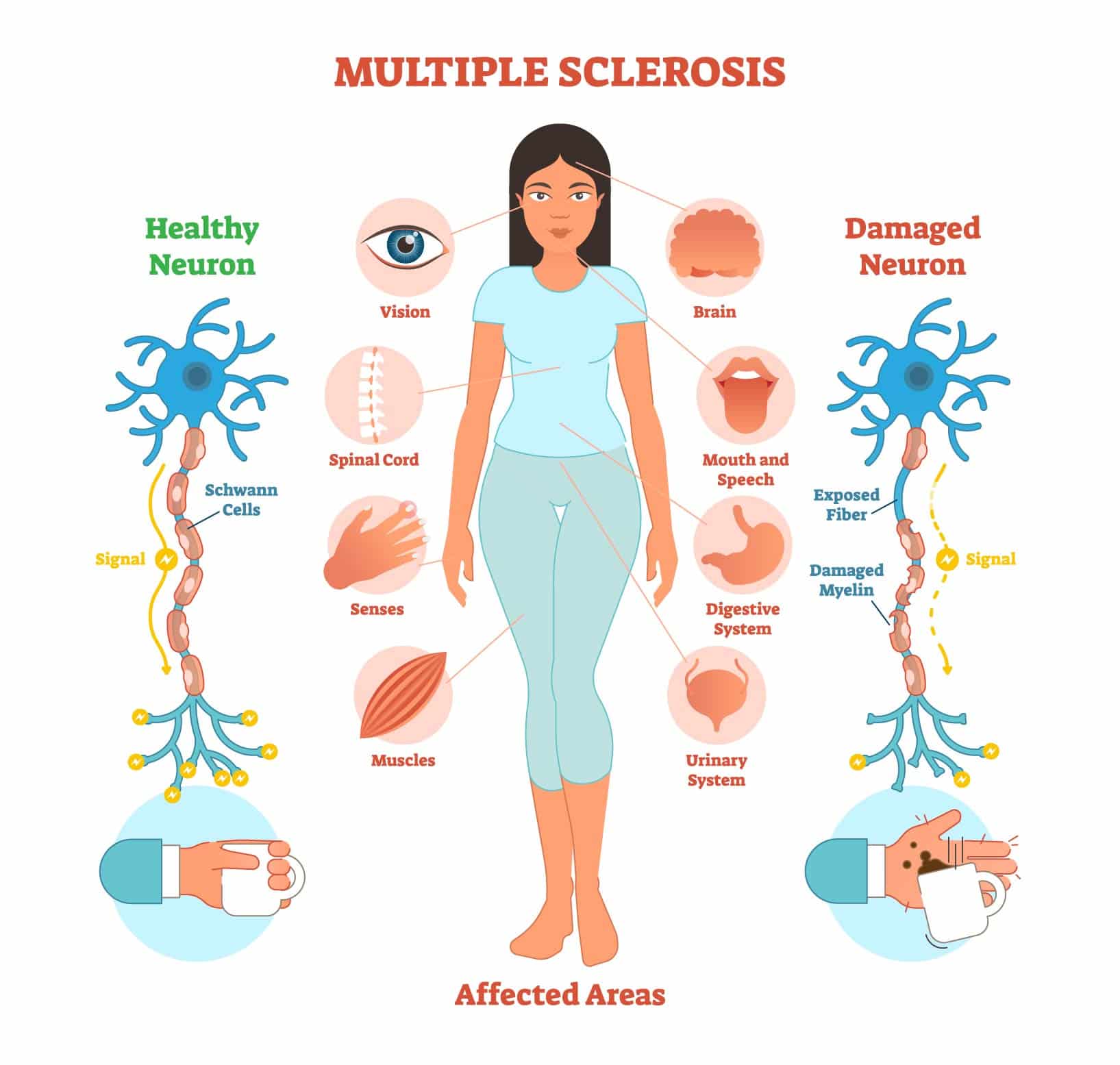 Multiple Sclerosis Symptoms In Men / Genentech Multiple Sclerosis ...